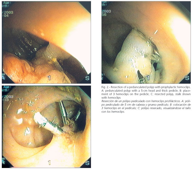 Polypectomy sites were not marked with India ink, nor was chromoendoscopy 