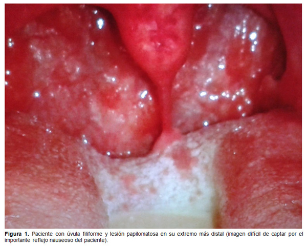 papiloma uvula tratamiento