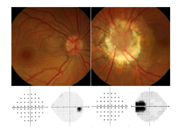desprendimiento de retina asociado a s u00edndrome de morning glory