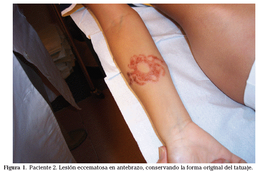 tatuaje con henna.  presentó a las 2 semanas de realizar un tatuaje con henna negra eritema 