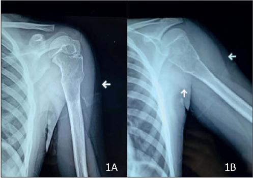 Preservación de extremidad torácica izquierda en osteosarcoma con