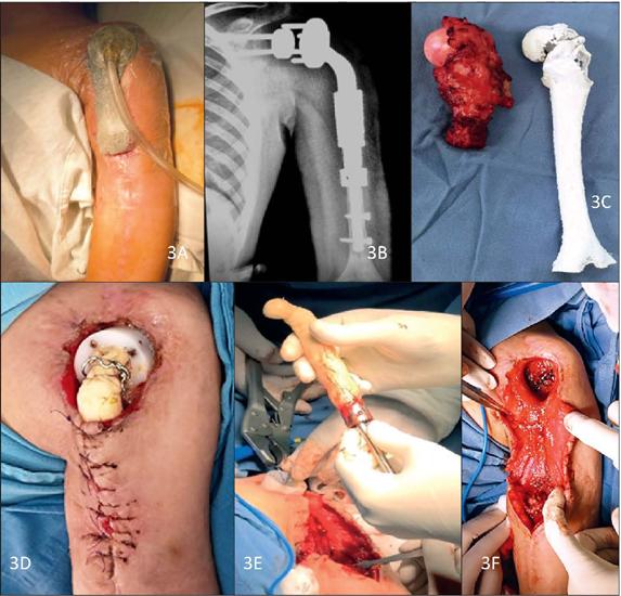 Preservaci N De Extremidad Tor Cica Izquierda En Osteosarcoma Con