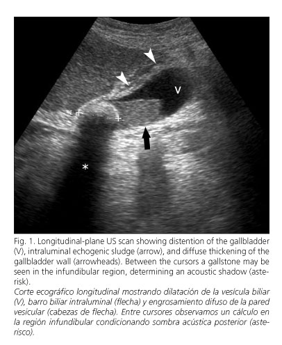 Acute Cholecystitis Ultrasound