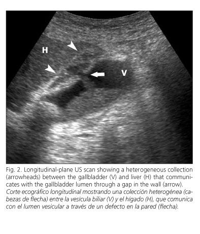 common bile duct ultrasound. distal common bile duct