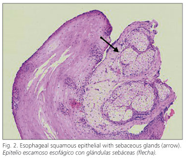 ectopic sebaceous glands