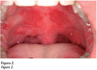La Mucosa Oral 46