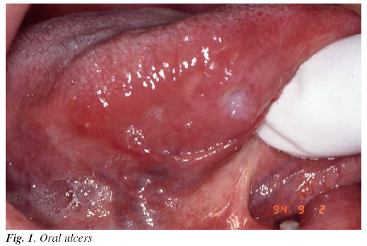 genital ulcer disease
