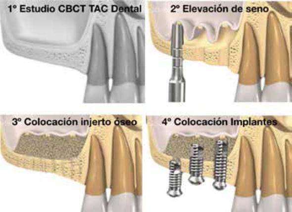 Cirugía de elevación del seno maxilar utilidad de las diferentes