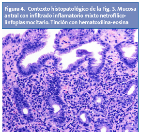 Figura 4. Contexto histopatológico de la Fig. 3. Mucosa antral con infiltrado inflamatorio mixto netrofílico-linfoplasmocitario. Tinción con hematoxilina-eosina