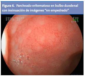 Figura 6. Parcheado eritematoso en bulbo duodenal con insinuación de imágenes en empedrado