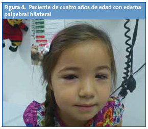 Paciente de cuatro años de edad con edema palpebral bilateral