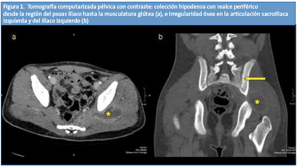 Figura 1. Tomografía computarizada pélvica con contraste: colección hipodensa con realce periférico desde la región del psoas ilíaco hasta la musculatura glútea (a), e irregularidad ósea en la articulación sacroilíaca izquierda y del ilíaco izquierdo (b)