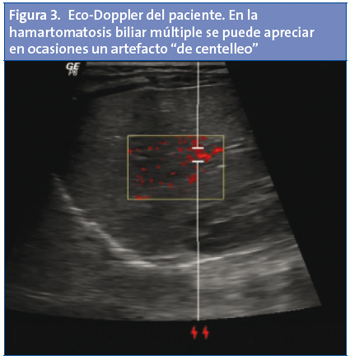 Figura 3. Eco-Doppler del paciente. En la hamartomatosis biliar múltiple se puede apreciar en ocasiones un artefacto de centelleo