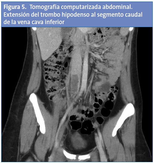 Figura 5. Tomografía computarizada abdominal. Extensión del trombo hipodenso al segmento caudal de la vena cava inferior