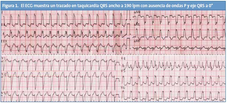 Figura 1. El ECG muestra un trazado en taquicardia QRS ancho a 190 lpm con ausencia de ondas P y eje QRS a 0º