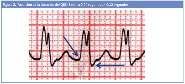 Figura 2. Medición de la duración del QRS: 3 mm x 0,04 segundos = 0,12 segundos
