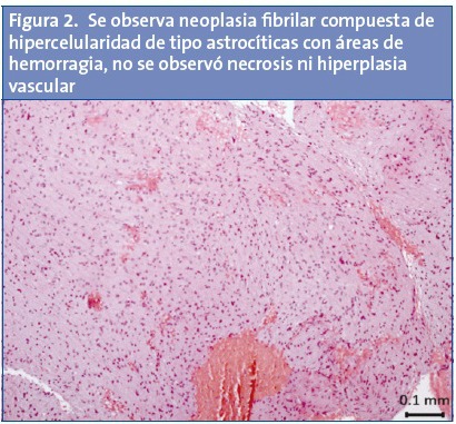 Figura 2. Se observa neoplasia fibrilar compuesta de hipercelularidad de tipo astrocíticas con áreas de hemorragia, no se observó necrosis ni hiperplasia vascular.