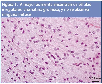 Figura 3. A mayor aumento encontramos células irregulares, cromatina grumosa, y no se observa ninguna mitosis