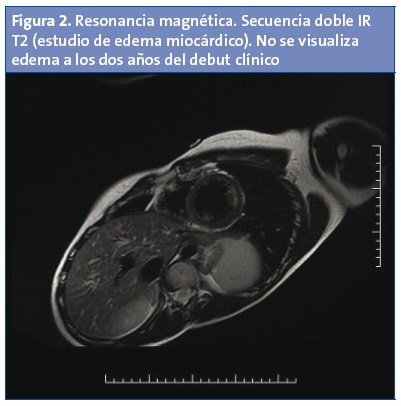 Figura 2. Resonancia magnética. Secuencia doble IR T2 (estudio de edema miocárdico). No se visualiza edema a los dos años del debut clínico