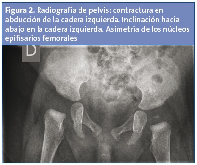 Figura 2. Radiografía de pelvis: contractura en abducción de la cadera izquierda. Inclinación hacia abajo en la cadera izquierda. Asimetría de los núcleos epifisarios femorales.