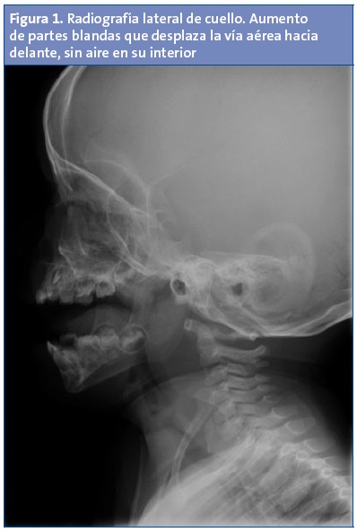 Figura 1. Radiografía lateral de cuello. Aumento de partes blandas que desplaza la vía aérea hacia delante, sin aire en su interior