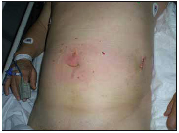 Figura 2. única herida quirúrgica.