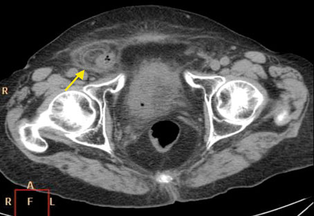 Figura 1. TAC abdominopélvico en el que se visualiza el apéndice vermiforme inflamado dentro del conducto inguinal.