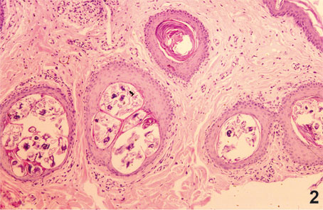 Figura 2. Moderado infiltrado inflamatorio perifolicular de células linfoides. En el ángulo superior derecho se muestra la epidermis. H-E. 100x.