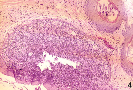 Figura 4. Foliculitis-forunculosis. Masas de PMN neutrófilos en un piogranuloma debido a la ruptura de un folículo. Se observa la presencia de parásitos. H-E. 100 x.
