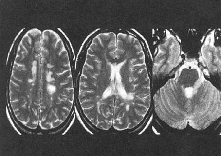 Figura 2. Imagen típica de EM en RMN encefálica.