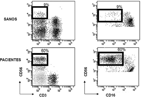 Figura 2. Subpoblaciones de células NK en los pacientes en comparación con sus controles sanos. Se puede observar como los ratios NKdim/NKbright están invertidos en los pacientes respecto a los controles sanos