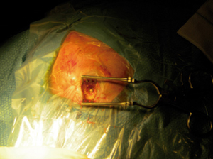 Figura 3. Craniectomía. Fotografía tomada durante la intervención quirúrgica urgente de drenaje del absceso cerebral mediante trepano