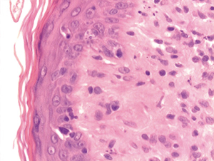 Figura 3. Margen subcutáneo de la lesión. Células dispersas que respetan la epidermis y pequeñas zonas de regresión espontánea. H-E. 200x