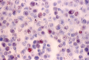 Figura 5. Inmunotinción para el antígeno nuclear de proliferación celular Ki-67. Muchas células presentan tinción positiva. Contraste con hematoxilina. 100x y 600x