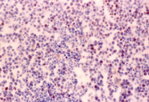 Figura 6 .Inmunotinción para el antígeno nuclear de proliferación celular Ki-67. Muchas células presentan tinción positiva. Contraste con hematoxilina. 100x y 600x