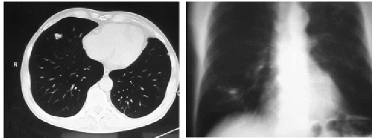 cáncer de próstata metástasis pulmonar