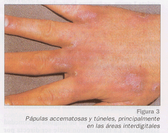 Qaraderma - Dermatología & Estética - La escabiosis, también conocida como sarna  humana, es la enfermedad producida por la presencia de los ácaros en la  piel del hombre llamada Sarcoptes scabiei. Esta