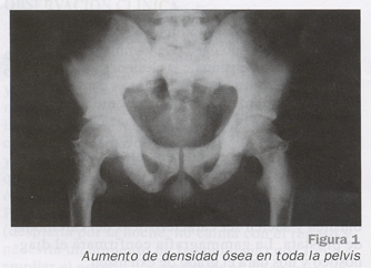 cáncer de próstata metástasis ósea síntomas)