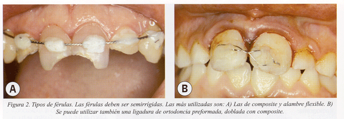 Férulas  Selectivo Dental