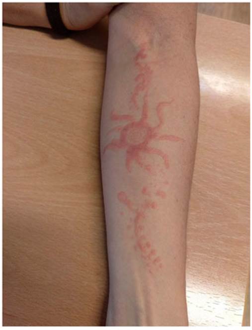 Alergia por henna: tatuajes que dejan huella