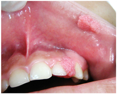 lesion de papiloma en boca