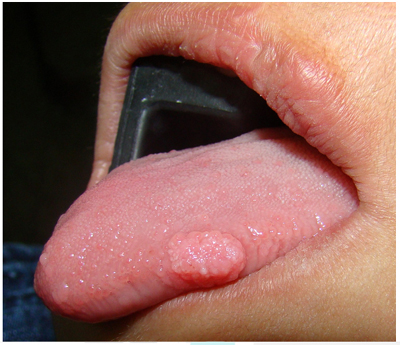 Virus de papiloma boca.