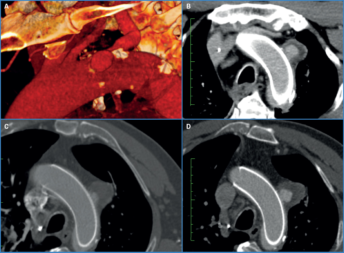 Aneurisma del arco aórtico. Tratamiento con stent multicapa diversor de ...