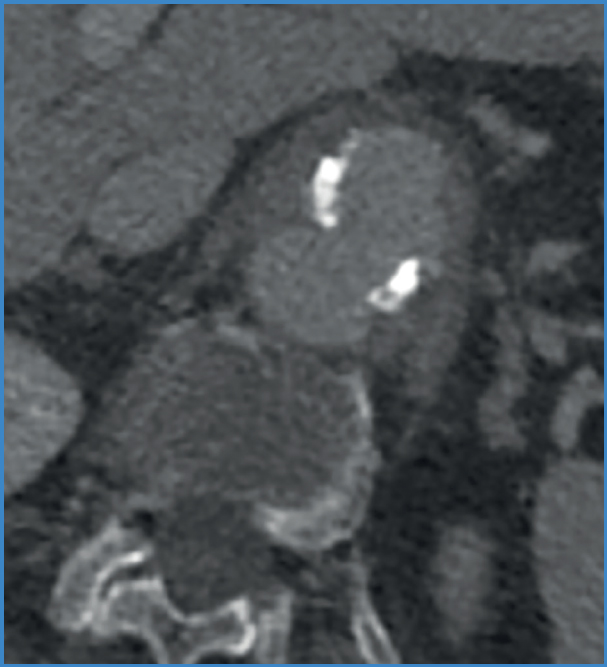 Tratamiento híbrido de aneurisma micótico de la aorta visceral