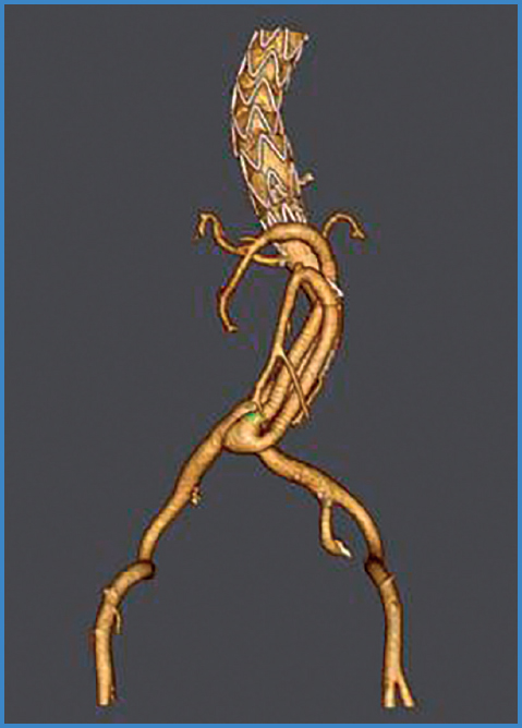 Tratamiento híbrido de aneurisma micótico de la aorta visceral