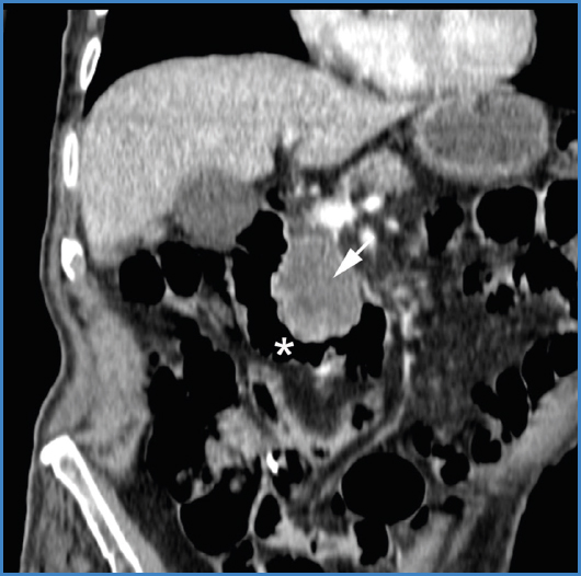 Aneurisma micótico aórtico con invasión duodenal