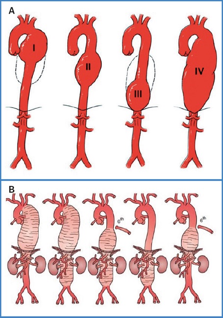 Aneurismas Da Aorta Torácica – Aneurismas da Aorta Torácica: A Que ...