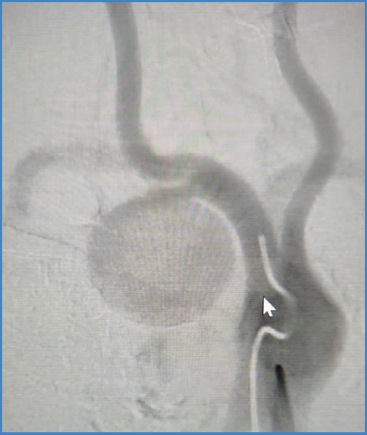 Tratamiento endovascular de aneurisma subclavio derecho en arco aórtico ...