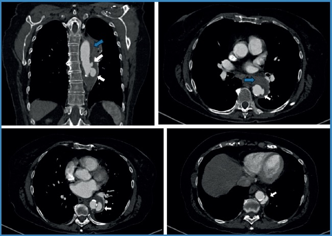 Radiografia De Aneurisma De Aorta Toracica Cirurgia De Aneurisma Da