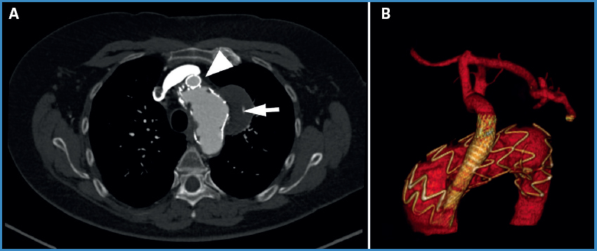 Aneurisma sacular del arco aórtico: tratamiento endovascular con ...